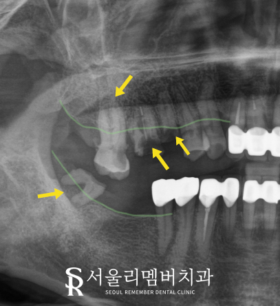 야간 진료 가능한 서울대입구역 치과 에서 퇴근 후에도 임플란트 하실 수 있습니다. 관련 이미지 3