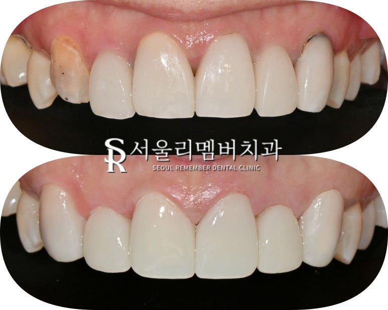 Nakseongdae Dental Clinic: If a front tooth laminate veneer falls off, can’t it just be reattached? Anterior crowns and Realnate re-prosthetics image 5