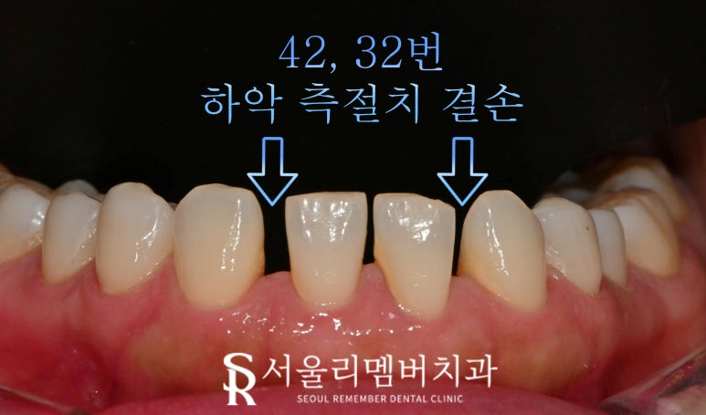 낙성대 치과 앞니 틀어짐 하악 전치 측절치 결손 라미네이트로 공간 닫기 성공 관련 이미지 3