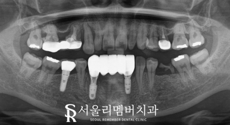 치주염으로 아래 앞니 흔들린다면? 신대방 치과 임플란트 브릿지 치료로 해결 관련 이미지 3
