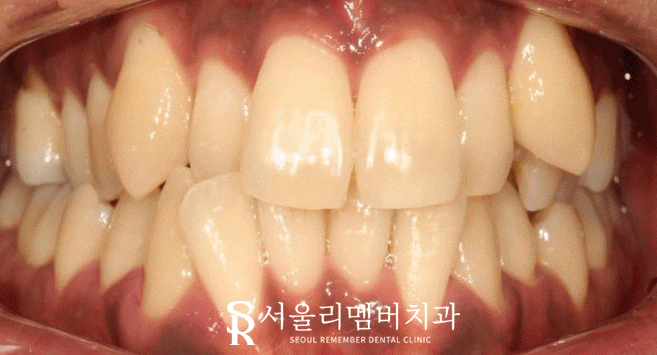 서울대입구역 치과 에서 들쑥날쑥 했던 치열, 비발치로 개선해 드렸습니다. 관련 이미지 1