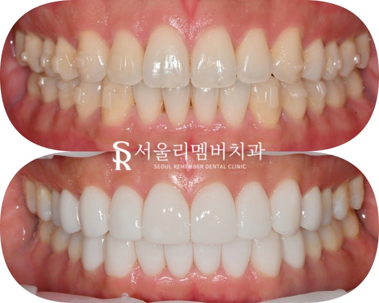 A Surge in Instagram DM Reservation Inquiries at Seoul National Univ. Entrance Station Dental Clinic: A Complete Rundown of Questions About Real Laminate image 2