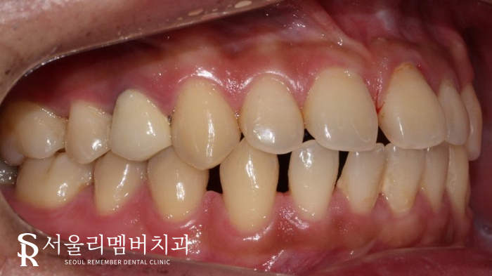 벌어진 치아, 사당 치과 인비절라인으로 개선할 수 있을까? 관련 이미지 3