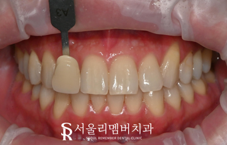 누런 이가 고민이라면? 봉천동 치과 전문가 원데이 치아미백으로 해결 관련 이미지 1