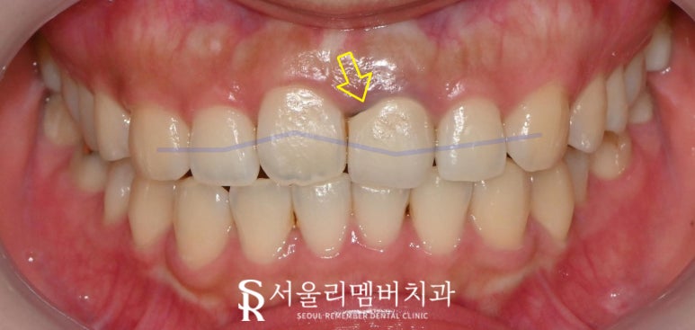 Sillim Dental Clinic: Crowded Front Teeth That Shifted Again and an Old PFM Crown, Zirconia Esthetic Prosthetic Treatment After Re-orthodontic Correction image 1