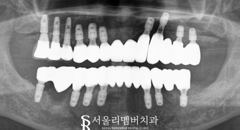 고난도 수술, 서울대입구역 임플란트 치과 에서 치료해야 되는 이유는? 관련 이미지 7