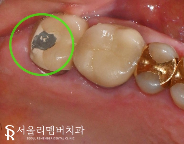치아 곳곳에서 생긴 문제, 사당 치과 임플란트 및 크라운 치료 관련 이미지 1