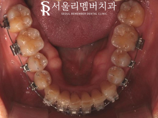 40대 교정 지금 시작해도 늦지 않을까요? 서울대입구역 치과 관련 이미지 9