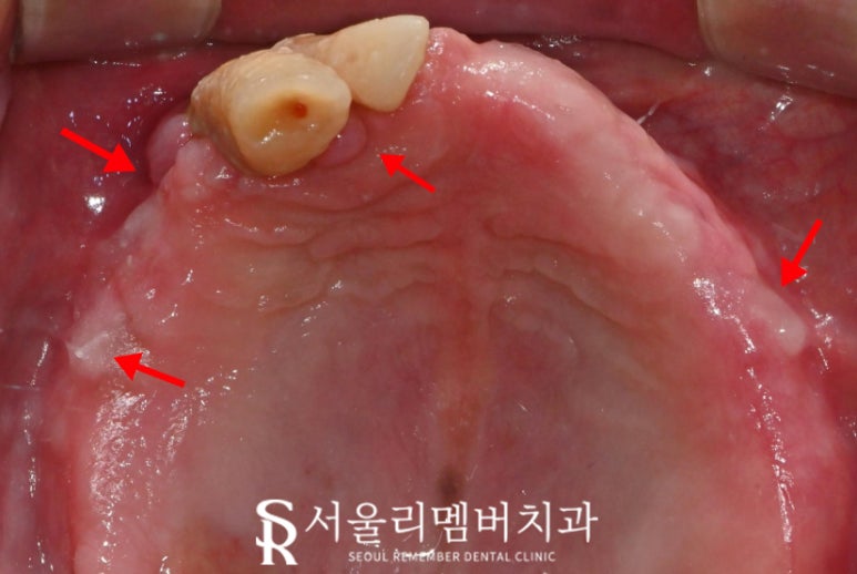 신대방 치과 고난도 전악 임플란트 수술 가능 관련 이미지 4