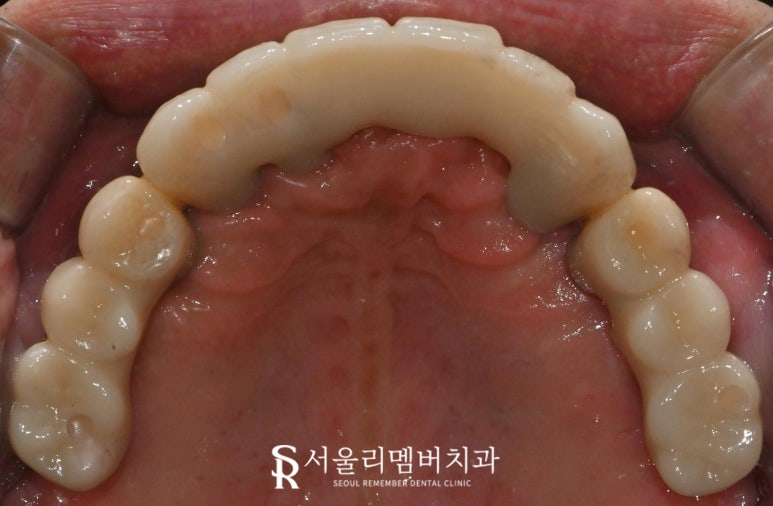 신대방 치과 에서 전악 수면마취 임플란트 수술로 전체 치아 회복시켜드렸습니다. 관련 이미지 6