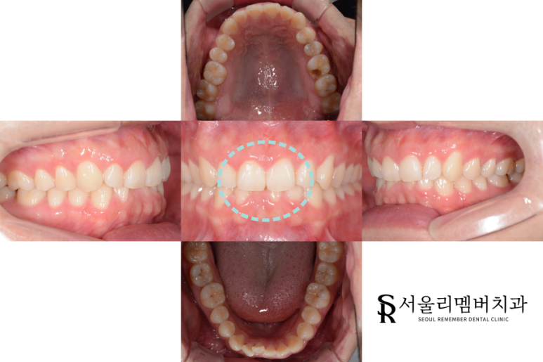 과개교합 케이스 전 관련 이미지 1