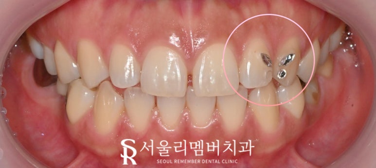 투스잼(tooth gem) 그냥 떼면 큰일난다? 상도동 치과 앞니 치아 손상 없이 레진 제거하는 방법 관련 이미지 1