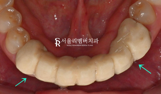 서울대입구역치과 에서 아래 앞니 5개를 임플란트 2개만으로 자연스럽게 회복 관련 이미지 5