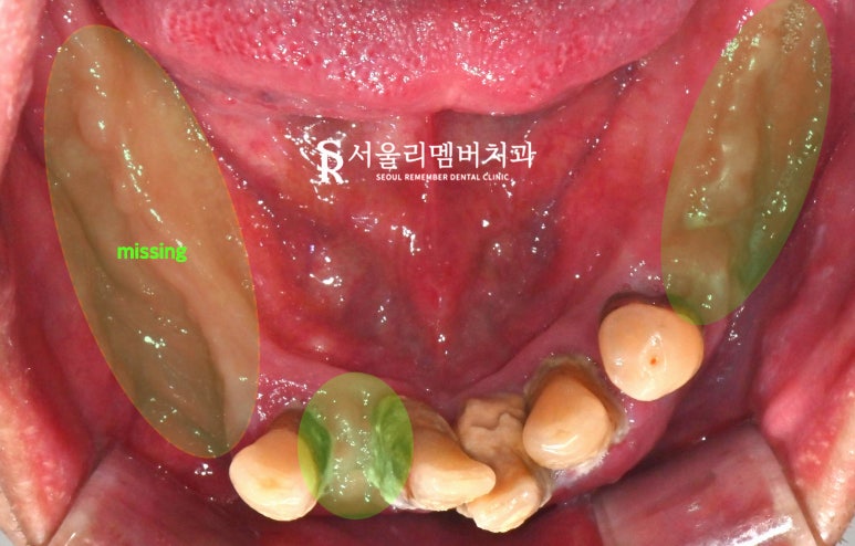 상도동 치과 위아래 다수의 치아 상실, 원가이드를 이용한 디지털 임플란트 로 상하악 전체 재건 가능 관련 이미지 4