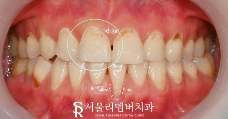 신대방 치과 앞니 끝(절단연) 약간 깨짐? 전치부 파절 레진 당일 치료 및 주의 사항 관련 이미지 5