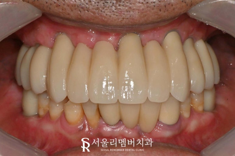 서울대입구역 치과 치아가 하나도 없는 무치악 환자를 위한 최소 비용 풀아치 임플란트 관련 이미지 6
