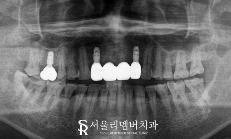서울대입구역 치과 오래된 브릿지 부러진 앞니 발치 후 네비게이션 임플란트 식립 사례 관련 이미지 3