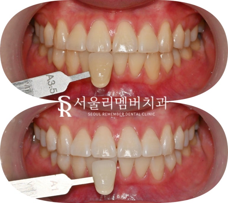 신림 치과 웨딩촬영 결혼 행사 앞두고 신경 쓰이는 누런 치아 하루 만에 밝게 만들 수 있을까? 관련 이미지 4