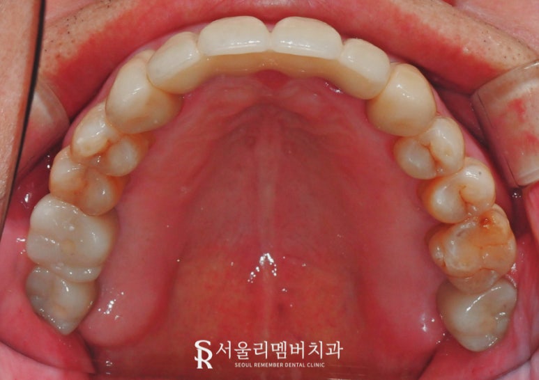 서울대입구역 치과 잇몸이 내려앉아서 고민이라면 전악 임플란트로 해결 관련 이미지 5