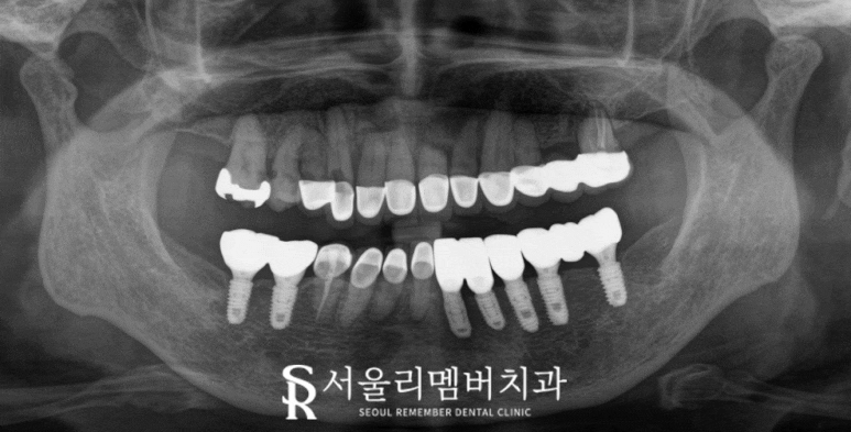 앞니 치아 뿌리 염증 당일 임플란트 하고 싶다면 신대방역 치과 관련 이미지 2
