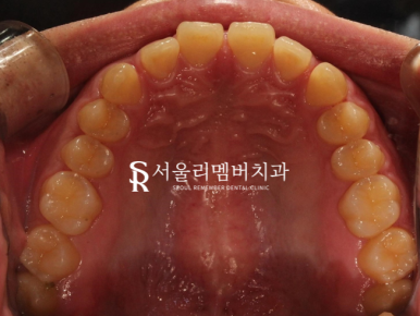 과개교합, 외적인 문제는 물론이며 기능 회복까지 개선하는 것이 중요합니다. 신대방치과 치아교정 관련 이미지 4