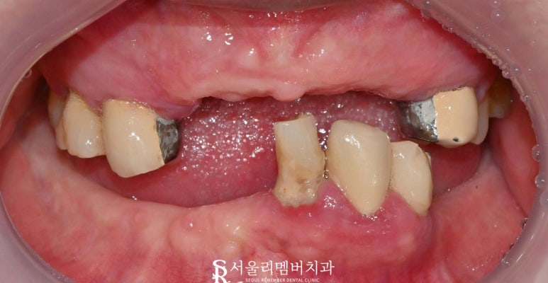 신림역 치과 "틀니는 쓰기 싫어요." 전체 임플란트 식립 후기 관련 이미지 2