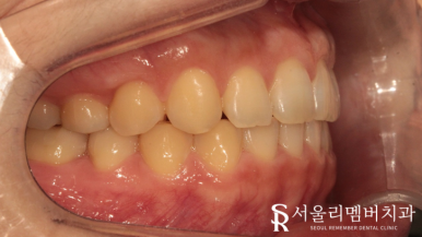 상도동치과 에서 발치 없이 깊게 물리는 과개교합 및 2급 부정교합 개선! 관련 이미지 8