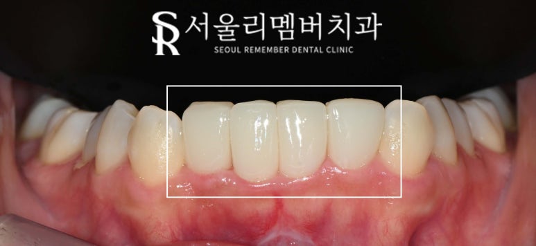 교정이 부담스러운데 치아 삐뚤빼뚤 총생 있다면 봉천역 치과 전치부 리얼네이트와 앞니 크라운 관련 이미지 5
