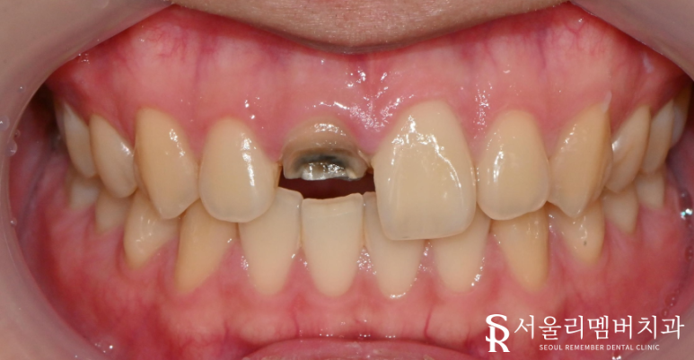 전치부 신경치료 과정과 주의사항은? (post&core) 영등포동 치과 관련 이미지 4