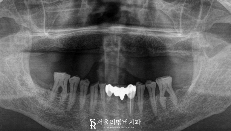 서울대입구역 치과 치아가 하나도 없는 무치악 환자를 위한 최소 비용 풀아치 임플란트 관련 이미지 4