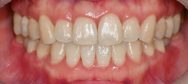 선천적 영구치 결손으로 남아있는 만기 잔존 유치, 서울대입구역 교정 치과 에서 투명 인비절라인 & 임플란트 케이스 관련 이미지 11