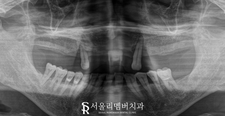 치아가 없을 땐? 서울대입구역 치과 에서 부기 통증 없는 최소절개 전체 디지털 임플란트 치료 관련 이미지 3