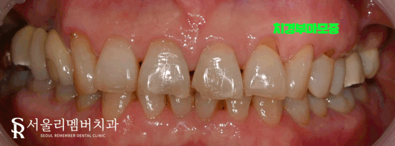 서울대입구역 치과 음식 찌꺼기가 계속 껴요. 관련 이미지 2