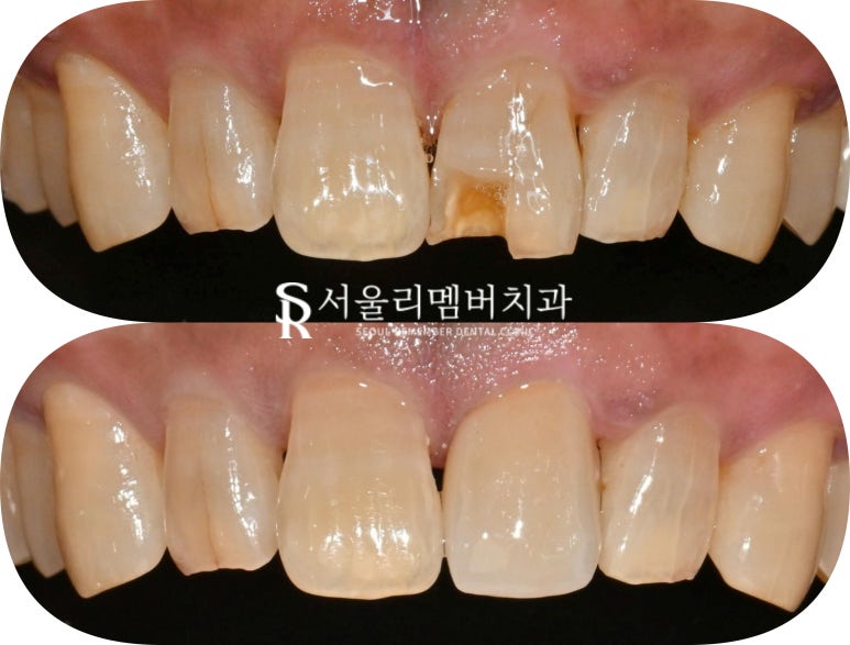 앞니가 깨졌다면? 상도동 치과 신경치료 없이 크라운만으로 자연치아 살리기 관련 이미지 5