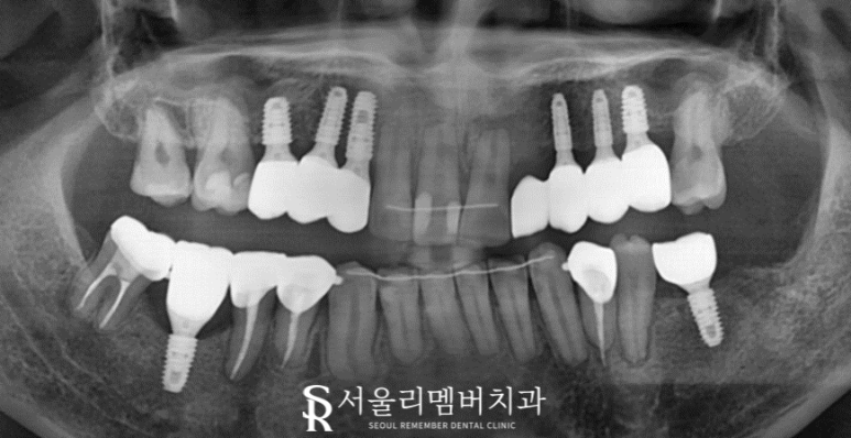 임플란트와 치아교정, 동시에 치료받을 수 있을까요? 남성역 서울 리멤버 치과 관련 이미지 9