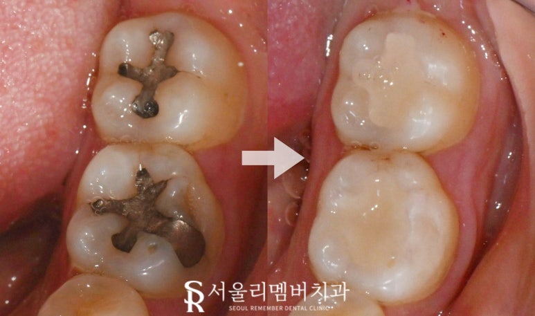 오래된 아말감 신림 치과 수면(의식하 진정) 마취 후 스트라우만 나이스 인레이로 교체 (좌우 2회로 나누어 진행 가능) 관련 이미지 8
