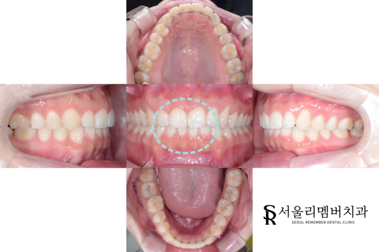 과개교합 케이스 후 관련 이미지 1