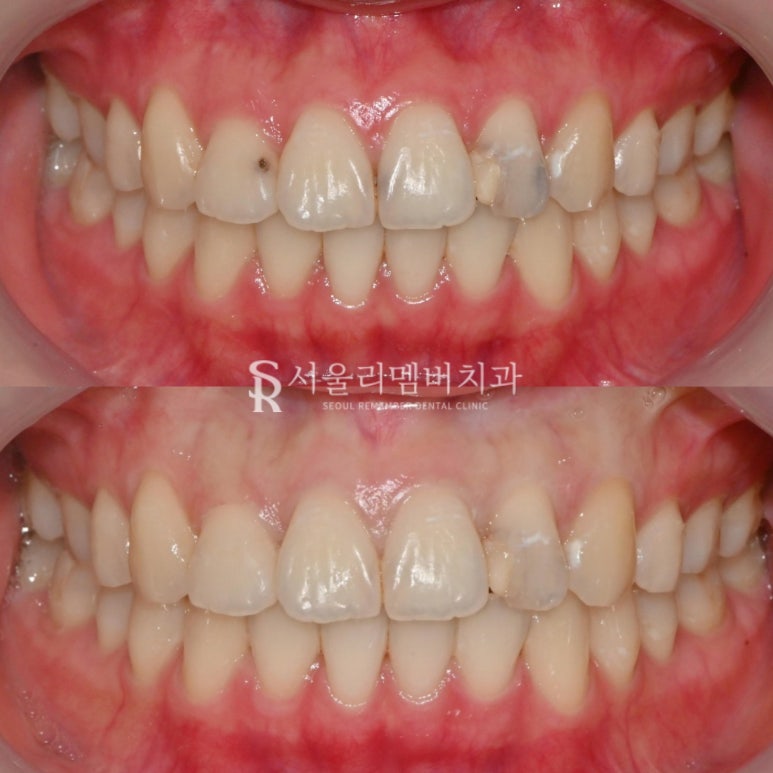 봉천동 치과 에서 충치치료 어금니 레진 수복 후기 관련 이미지 3