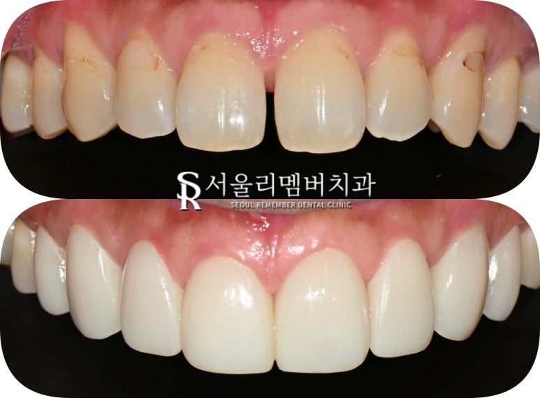 Improving Spaces Between the Front Teeth and Dark Staining from Discolored Resin at the Same Time: Anterior Laminate Veneers and Realnate at Seoul National University Entrance Station Dental Clinic image 4