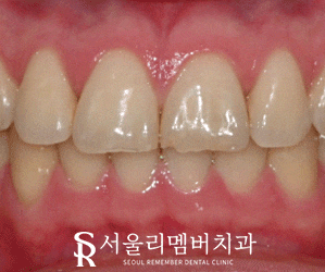 앞니 끝 깨짐 치료, 낙성대 치과 티 안 나는 레진으로 수복하기 관련 이미지 3