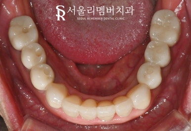 사당 치과 하악 전치 신경치료 브릿지로 살리고 나머지 임플란트로 재건한 전악 증례 관련 이미지 14