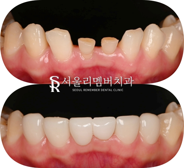 사당 치과 아래 앞니 만기 잔존 유치 크라운과 리얼네이트 동시에 심미 보철 치료 관련 이미지 2