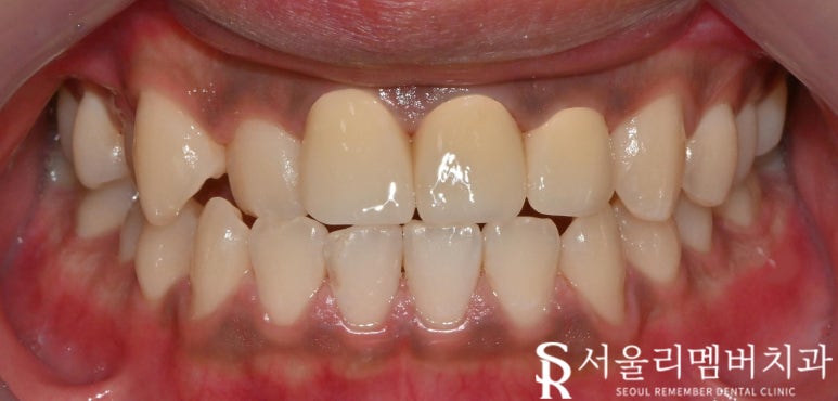심하게 부러진 앞니의 해결 방안은? 상도동 치과 신경치료 과정 통해 알 수 있습니다. 관련 이미지 2