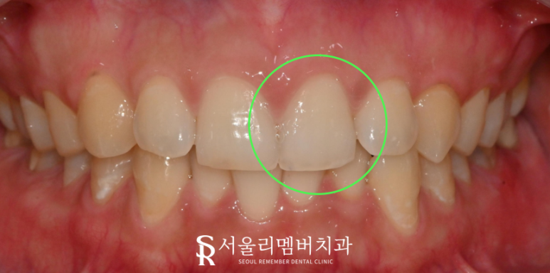 서울대입구역 치과 앞니 깨짐은 레진 당일 충전으로 심미 수복 치료하면 고민 해결 관련 이미지 3