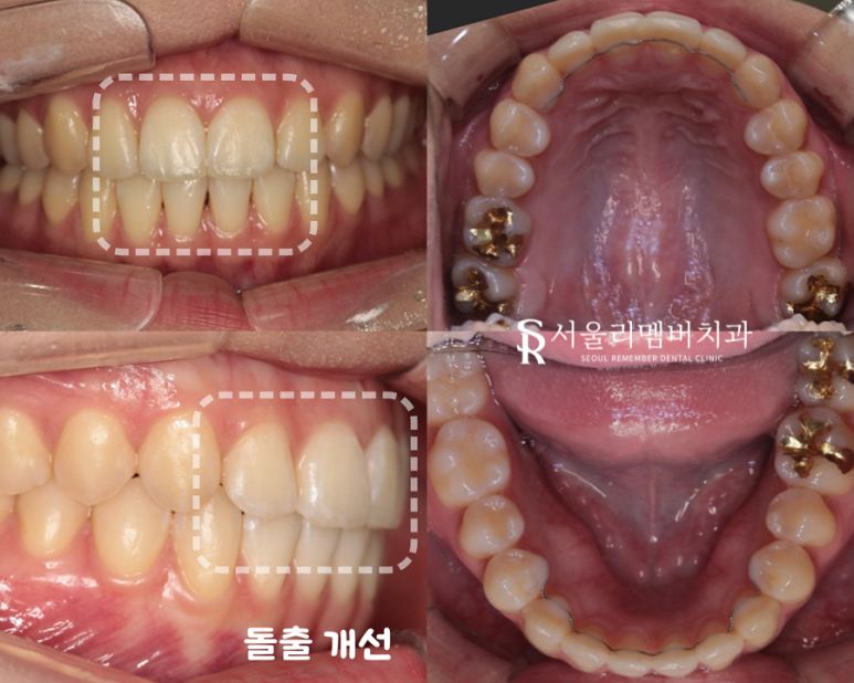 서울대입구역치과 "교정할 때 이를 꼭 뽑아야 되나요?" 돌출입 비발치 개선 관련 이미지 4