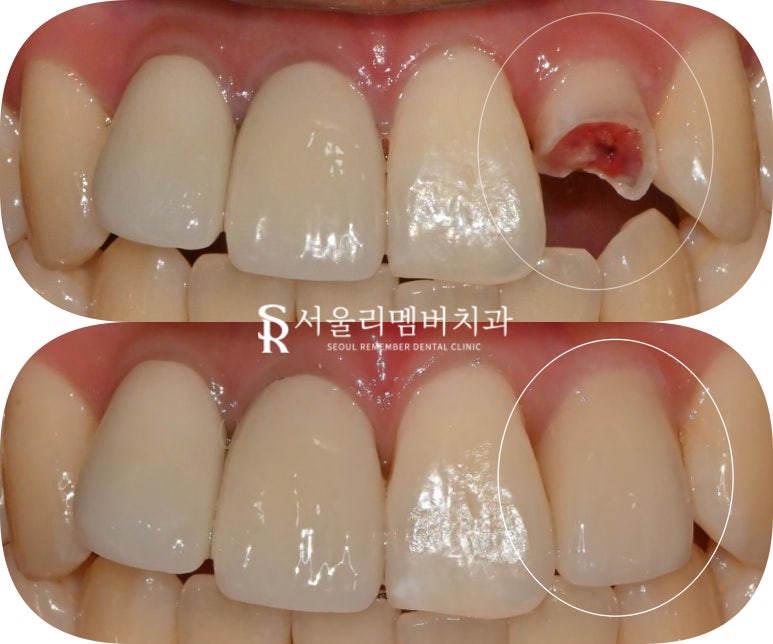 서울대입구 치과 앞니 심한 파절 및 신경치료 + 포스트 코어 + 지르코니아 심미 보철 크라운 진료 과정 관련 이미지 3