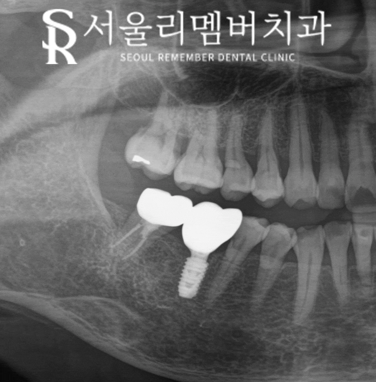 Root Fracture Caused by Secondary Decay Under a Gold Crown, Immediate Implant After Extraction at Sadang Station Dental Clinic image 4