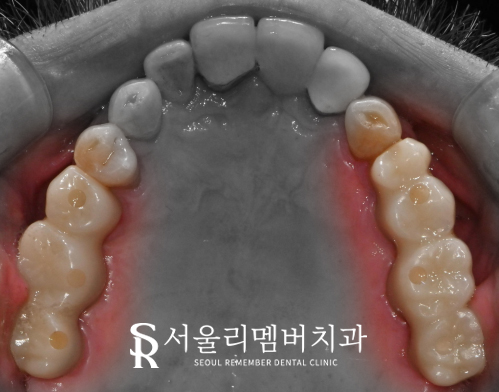 봉천동 치과 임플란트 치료 과정, 어금니가 없어서 식사가 어려워요. 관련 이미지 8