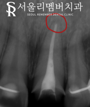 신길동 치과 부러진 앞니, 신경치료로 티 안 나게 개선 완료! 관련 이미지 5