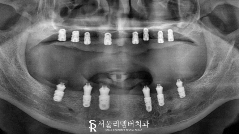 오랜 틀니 착용으로 잇몸이 다 망가졌던 분.. 임플란트 식립으로 밝은 미소 되찾아드렸습니다! 서울대입구역 서울 리멤버 치과 관련 이미지 5
